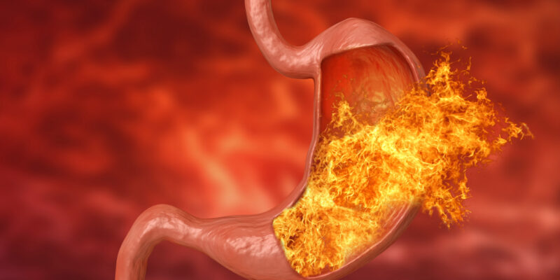 How Long Does Acid Reflux Last? Symptoms & Relief in 2026