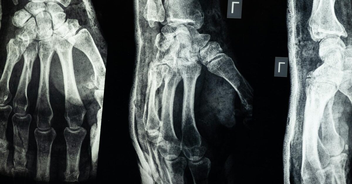 Fracture vs. Break: Understanding Bone Injury Terms in 2026