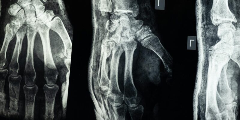 Fracture vs. Break: Understanding Bone Injury Terms in 2026