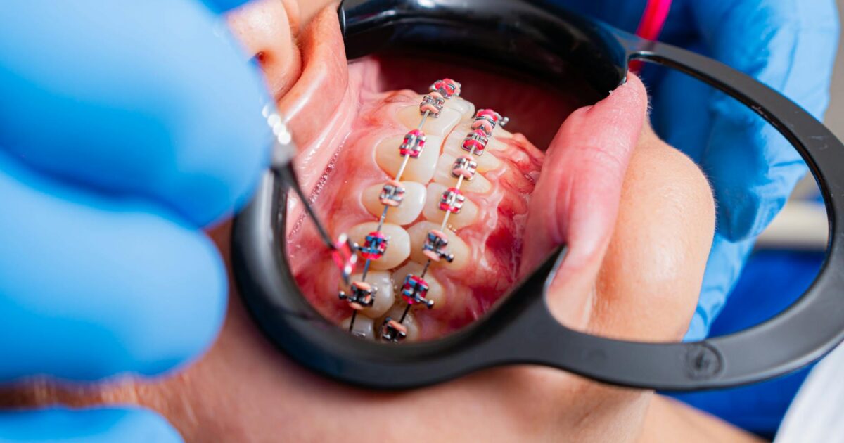 Gold Braces: Your Ultimate Guide to a Dazzling Smile in 2026