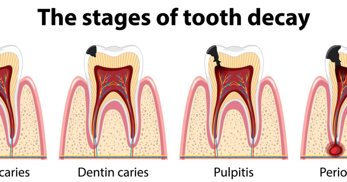 Rotting Teeth: Signs, Causes & Treatments (2026 Update)