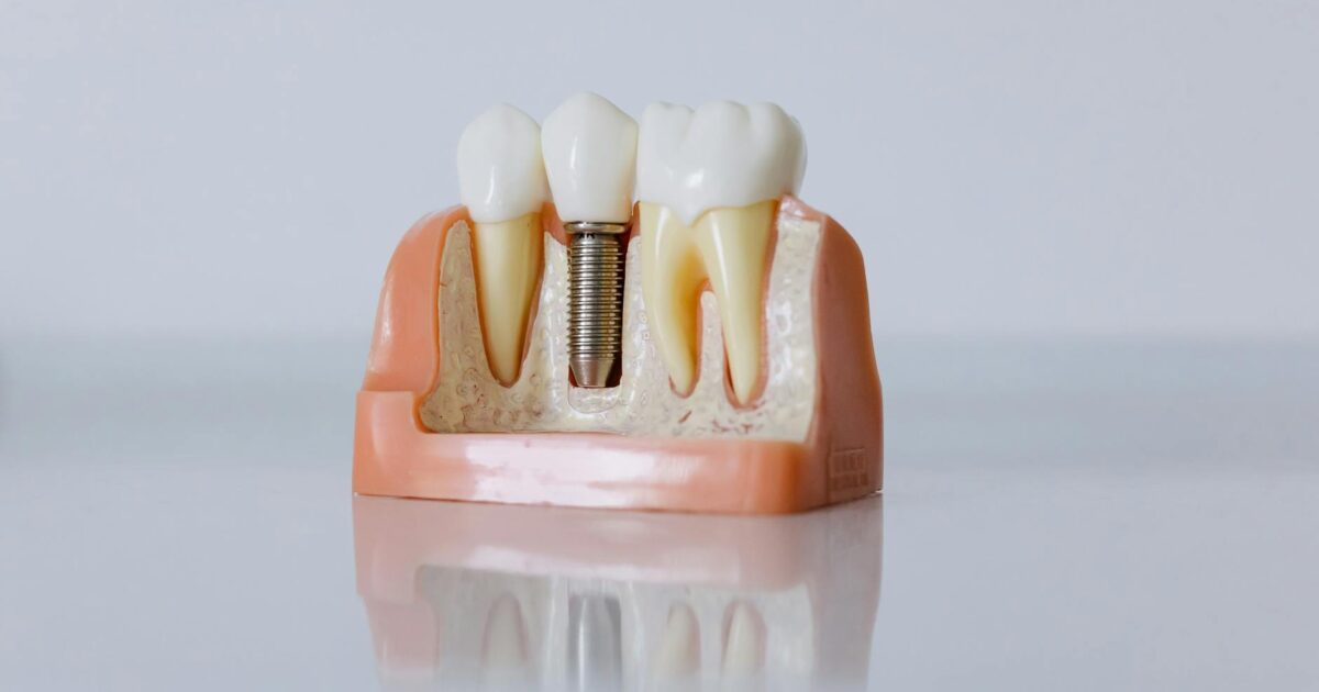 Impla Dental: Your Complete Beginner’s Guide 2026