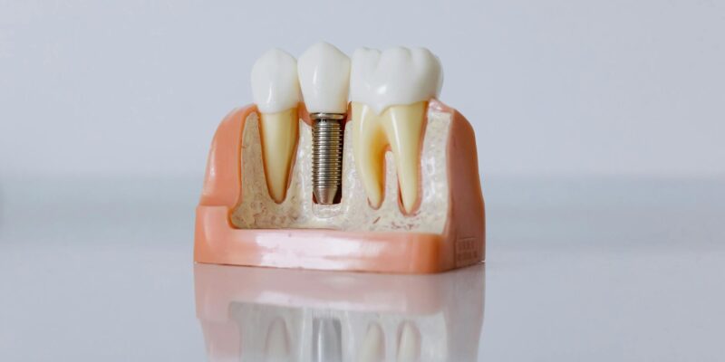 Impla Dental: Your Complete Beginner’s Guide 2026