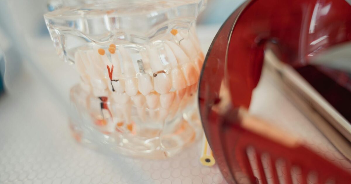 Impla Dental: Your Complete Beginner’s Guide