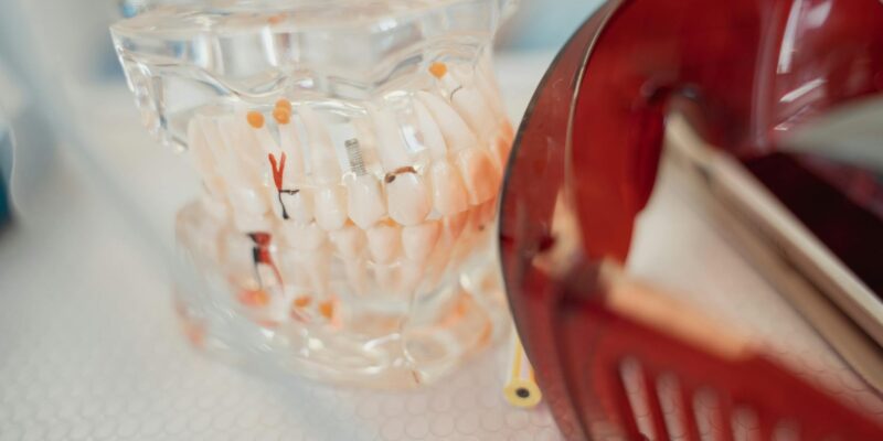 Impla Dental: Your Complete Beginner’s Guide